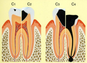 虫歯の図解